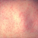 Allarme morbillo: aumentano i casi